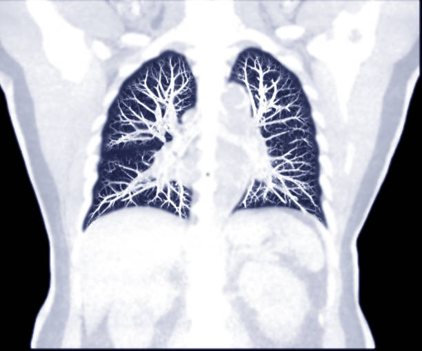 selektiver fokus der ct chest coronal mip ansicht. - human heart heart attack x ray image chest stock-fotos und bilder