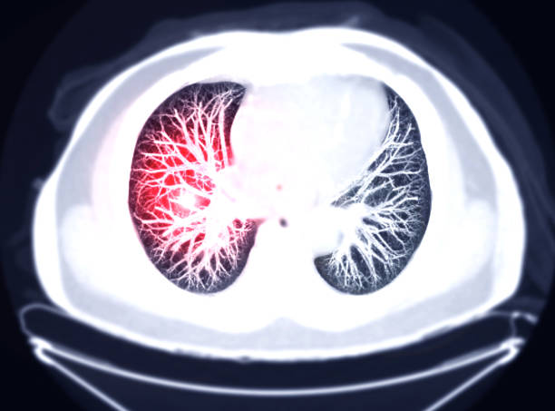 selektiver fokus der ct brust axial mip ansicht für diagnostische lungenembolie (pe) , lungenkrebs und covid-19. - human heart heart attack x ray image chest stock-fotos und bilder