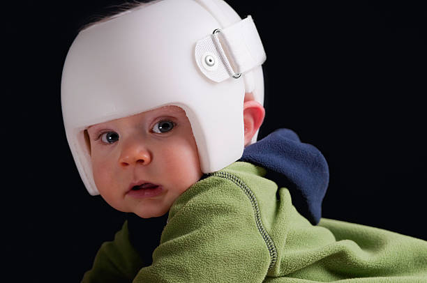 Cranial Remolding helmet worn for the treatment of plagiocephaly A seven month old baby wearing a helmet or "band' for the treatment of plagiocephaly, or misshapen head. plagiocephaly stock pictures, royalty-free photos & images