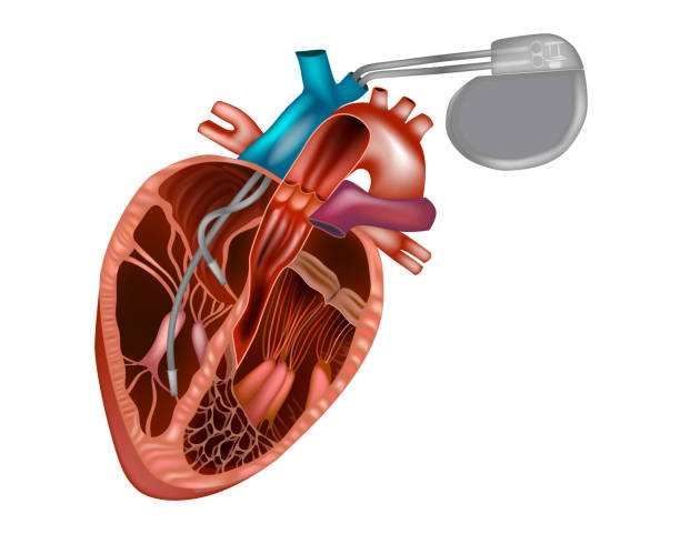 herzschrittmacher oder künstlicher herzschrittmacher. - herzschrittmacher stock-grafiken, -clipart, -cartoons und -symbole