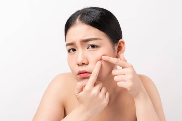 mujer asiática exprimiendo granos en su cara, concepto de estilo de vida para el cuidado de la piel. - dot gain fotos fotografías e imágenes de stock