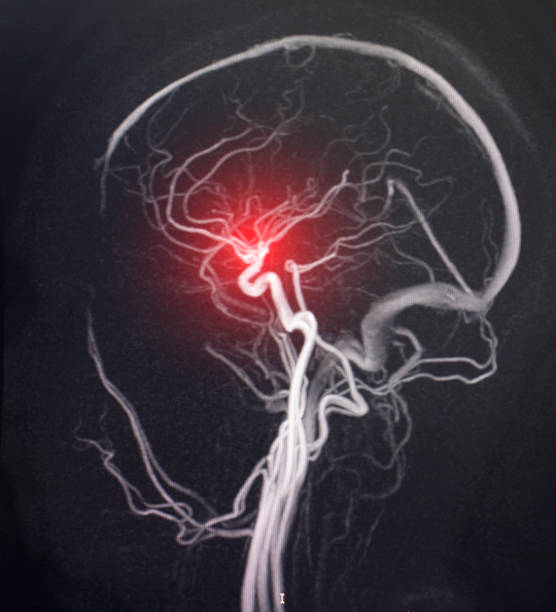 MRI image of a brain vessel. The concept of cerebrovascular disease, stroke and circulatory disorders, atherosclerosis MRI image of a brain vessel. The concept of cerebrovascular disease, stroke and circulatory disorders, atherosclerosis, hypertonic disease hematoma images stock pictures, royalty-free photos & images