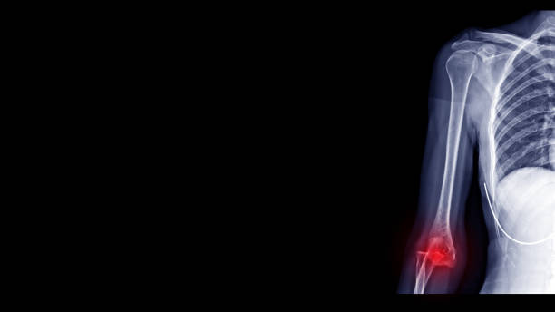 Film X ray : elbow dislocation la radiografía de codo de rayos x de película muestra dislocación del codo. el paciente tiene lesiones por luxación articular por accidente de tráfico. punto culminante rojo en el sitio de dislocación y zona dolorosa. radiografía médica y concepto