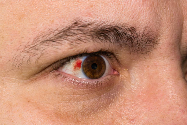травма глаза, молодой человек с разрыва кровеносным сосудом в глазу, усталость, проблемы с кровеносными сосудами - 4811 стоковые фото и изображения