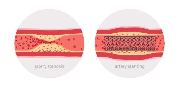 stenting chora tętnica ludzka - cholesterol atherosclerosis human artery illness stock illustrations