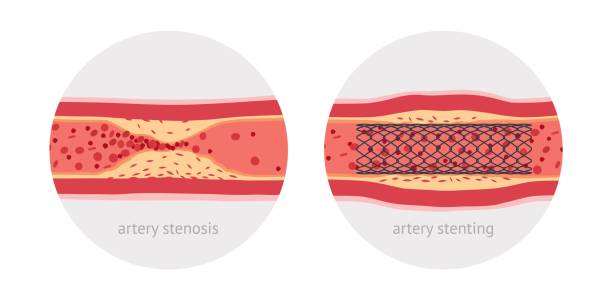 Stenting sick human artery Stenting sick human artery, before and after, flat design illustration human artery stock illustrations