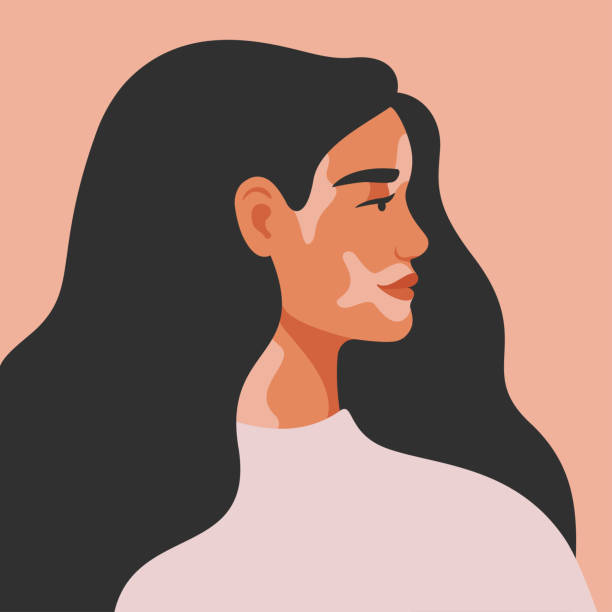 Portrait of an young woman with vitiligo in profile. Portrait of an young woman with vitiligo in profile. Avatar of young girl with pigmentation on the skin. Vector illustration vitiligo girl stock illustrations