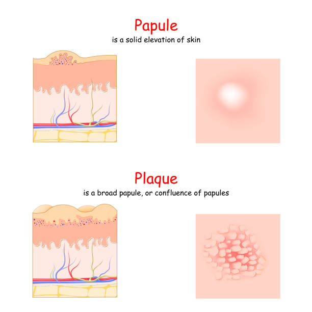 Skin lesion. Papule and Plaque. side and top view. Cross section of the human skin. Skin lesion. Papule and Plaque. side and top view. Cross section of the human skin. Papule is a solid elevation of skin. Plaque is a broad papule. infected wound stock illustrations