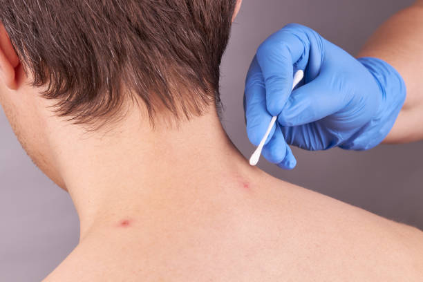 istock caucasian male with skin problems. acne check. skin care concept. 1217664761
