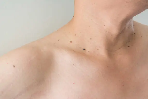 Photo of Mole on men's skin isolates white background