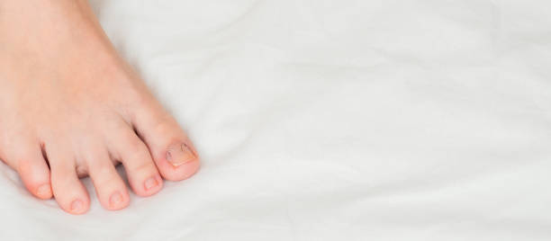 istock Toenail clamp is mounted on an ingrown toenail 1217725748