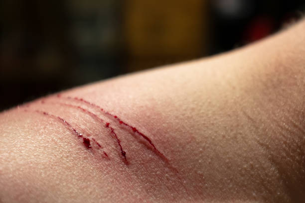 Fresh, bleeding wound on the shoulder, from cats claws, after combined games and fun. Fresh, bleeding wound on the shoulder, from cats claws, after combined games and fun. Close-up. skin scrape stock pictures, royalty-free photos & images