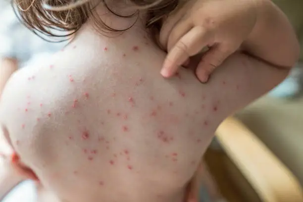 Photo of Baby girl scratching her chickenpox rash on the back