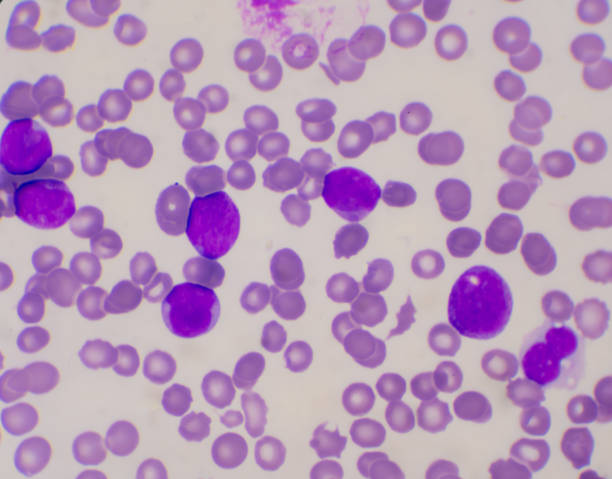 혈액 얼룩 백혈병 개념에 미성숙 한 백혈구. - leukemia pathologist blood hematologist 뉴스 사진 이미지