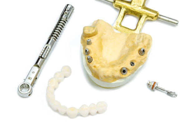 istock white ceramic teeth with dental implants on a white background. torque wrench and dental screwdriver. concept of dental implantation and orthopedic dentistry on implants. dental abutment is twisted 1218065207