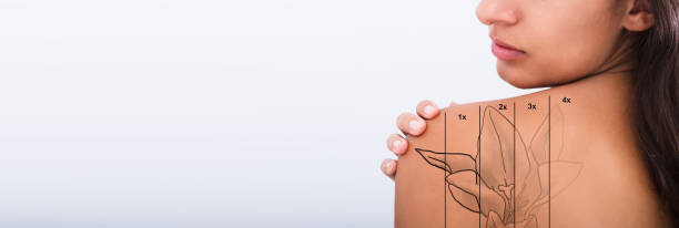 istock Tattoo Removal On Woman's Shoulder 1218132189