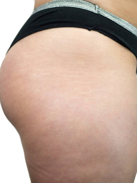 istock Female thigh legs with cellulite. Skin problem, topic entry, explosive weight and diet, diabetes risk factor 1218162551