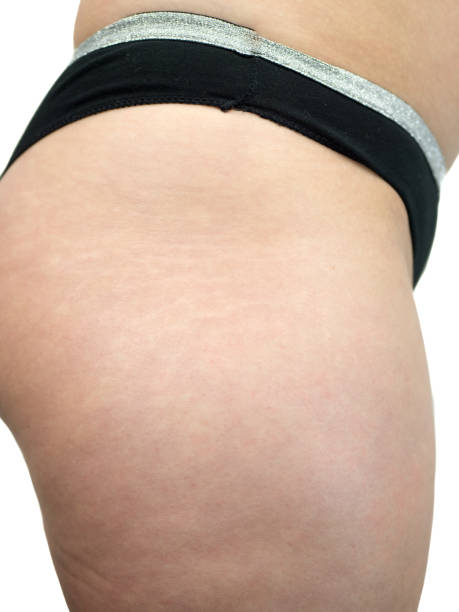 istock Closeup of female thighs with stretch marks Skin problem, entry for theme, explosive weight and diet, diabetes risk factor 1218162673
