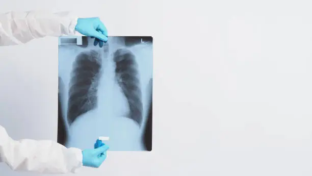 Photo of Lungs x-ray film in doctor hands wearing medical gloves and PPE suit which showing scan-film of uncommon respiratory syndrome or pneumonia disease or unhealthy-lung that infected by Coronavirus or Covid-19