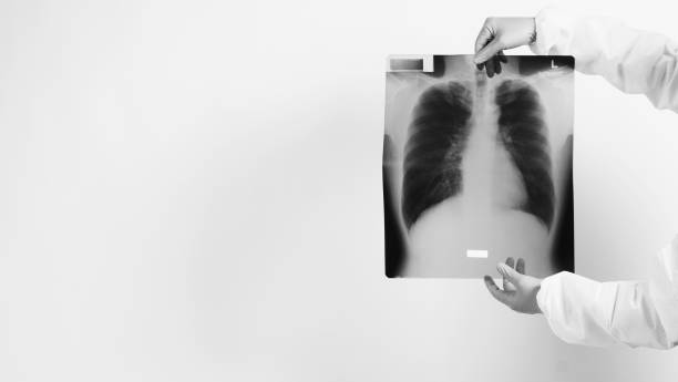 Lungs x-ray film in doctor hands wearing medical gloves and PPE suit which showing scan-film of uncommon respiratory syndrome or pneumonia disease or unhealthy-lung that infected by Coronavirus or Covid-19 película de rayos x de los pulmones en las manos del médico con guantes médicos y traje de epp que muestra una película de exploración de síndrome respiratorio poco frecuente o enfermedad de neumonía o pulmón no saludable infectado por coronavirus
