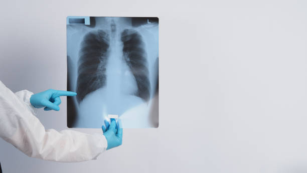Lungs x-ray film in doctor hands wearing medical gloves and PPE suit which showing scan-film of uncommon respiratory syndrome or pneumonia disease or unhealthy-lung that infected by Coronavirus or Covid-19 película de rayos x de los pulmones en las manos del médico con guantes médicos y traje de epp que muestra una película de exploración de síndrome respiratorio poco frecuente o enfermedad de neumonía o pulmón no saludable infectado por coronavirus