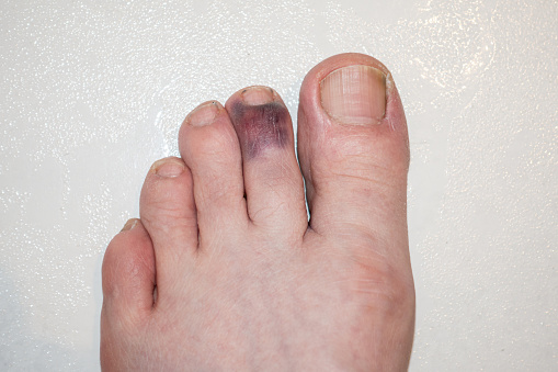 Male adult left foot with stubbed and badly bruised index toe on a white background