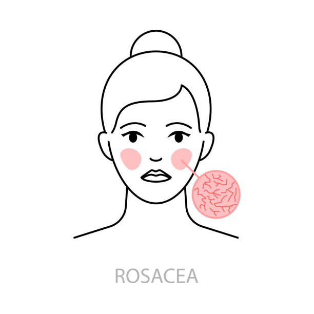 rosacea vektor-symbol-linien-stil - rosazea stock-grafiken, -clipart, -cartoons und -symbole