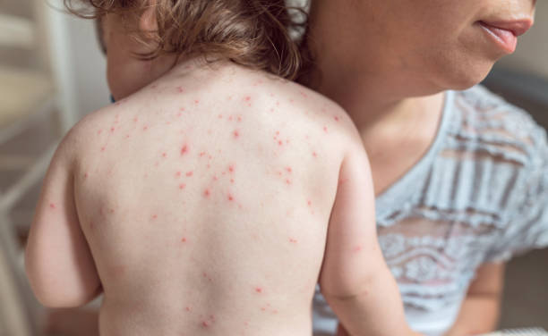 Baby girl infected with varicella zoster virus Rear view image of little girl with chickenpox rash on her back shingles rash stock pictures, royalty-free photos & images