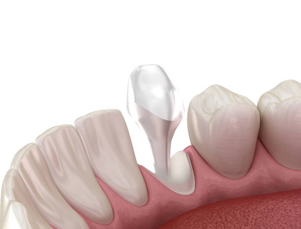 istock Stump pin tab on canaine tooth. Medically accurate dental 3D illustration 1218385200