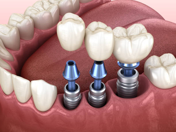 3 tooth crowns placement over 3 implants - concept. 3d illustration of human teeth and dentures - implantat imagens e fotografias de stock