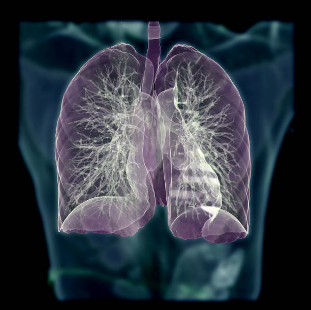 istock CT Chest or Lung 3D rendering image on blurred human body background for diagnosis TB,tuberculosis and covid-19 . 1218489263