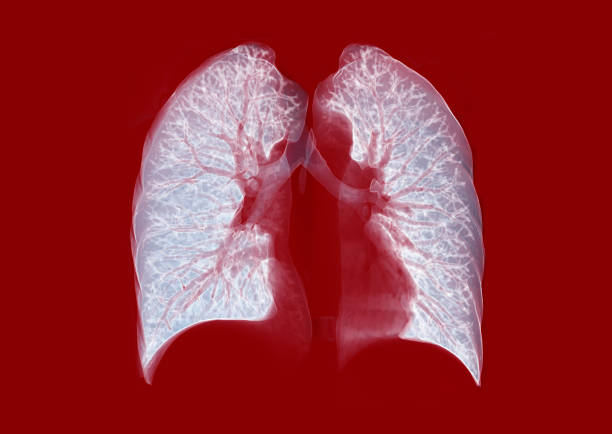 istock CT Chest or Lung 3D rendering image on red background for diagnosis TB,tuberculosis and covid-19 . 1218489286