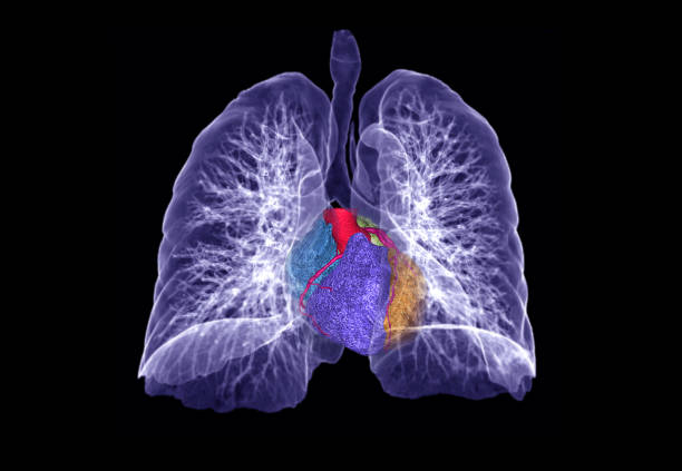 istock CT Chest or Lung 3D rendering image with 3D heart for diagnosis TB,tuberculosis and covid-19 . 1218489291