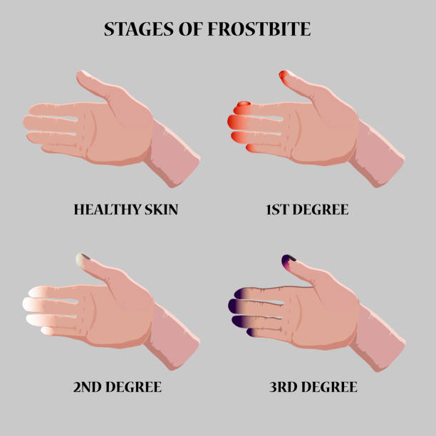 ilustrações de stock, clip art, desenhos animados e ícones de medical vector illustration. frostbite stages. blue and red frostbitten fingers.  stages of hypothermia in cold season. - congelação