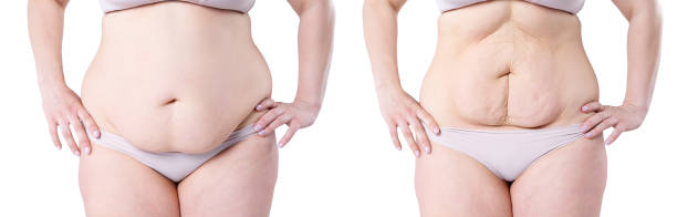 Woman's body before and after weight loss isolated on white background Woman's body before and after weight loss isolated on white background, plastic surgery concept female navel stock pictures, royalty-free photos & images