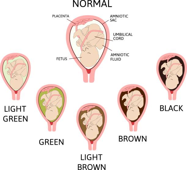 ilustrações de stock, clip art, desenhos animados e ícones de color of amniotic fluid in the amniotic sac. normal and danger variants. - placenta baby childbirth newborn