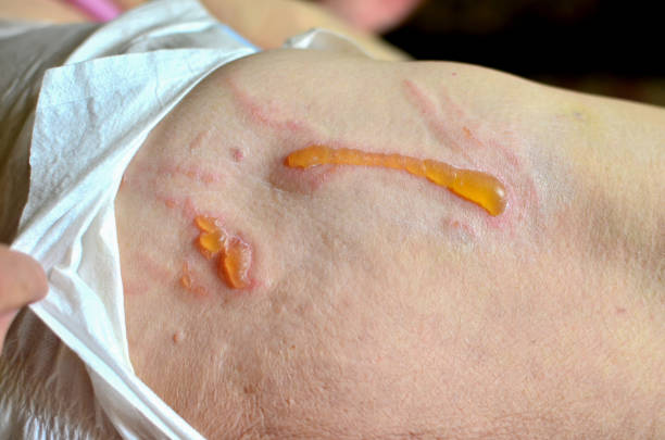 Decubitus ulcer. Pressure ulcers on skin tissue. The increased pressure prevents the blood from circulating properly, and causes cell death, tissue necrosis and the development of pressure ulcers Decubitus ulcer. Pressure ulcers on skin tissue. The increased pressure prevents the blood from circulating properly, and causes cell death, tissue necrosis and the development of pressure ulcers eschar stock pictures, royalty-free photos & images