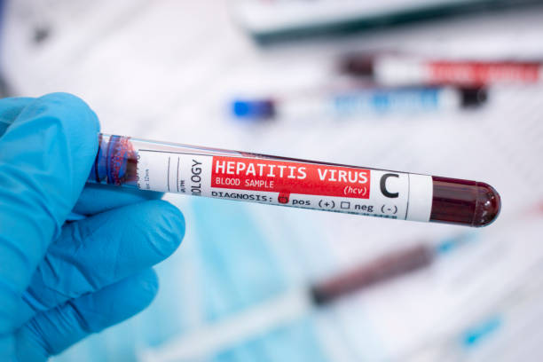 sampel darah dengan virus yang terinfeksi - hepatitis potret stok, foto, & gambar bebas royalti