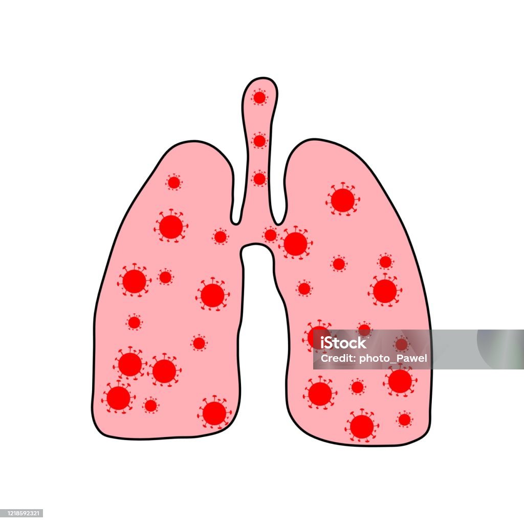 Ilustración de Pulmones Enfermos Con Coronavirus Cóvido19 Células De Virus En El Pulmón Pulmones Infectados Coronavirus Covid19 2019ncov Enfermedad Pulmonar y más Vectores Libres de Derechos de Alerta - iStock Ilustración de Pulmones Enfermos Con Coronavirus Cóvido19 Células De Virus En El Pulmón Pulmones Infectados Coronavirus Covid19 2019ncov Enfermedad Pulmonar y más Vectores Libres de Derechos de Alerta - iStock