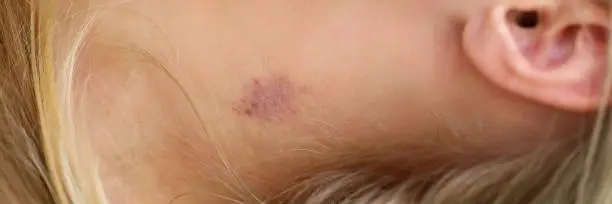 Close-up of womans neck with small bruise. Blue and red colour mark on female skin. Hickey or love bite. Domestic violence or simple body injury concept