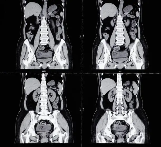Photo of MRI Scan Human Abdominal Tomography
