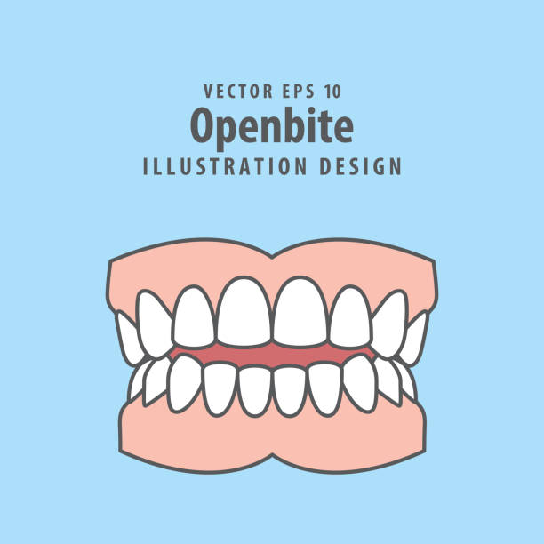 dental openbite zähne illustration vektor-design auf blauem hintergrund. zahnpflegekonzept. - fehlbiss stock-grafiken, -clipart, -cartoons und -symbole