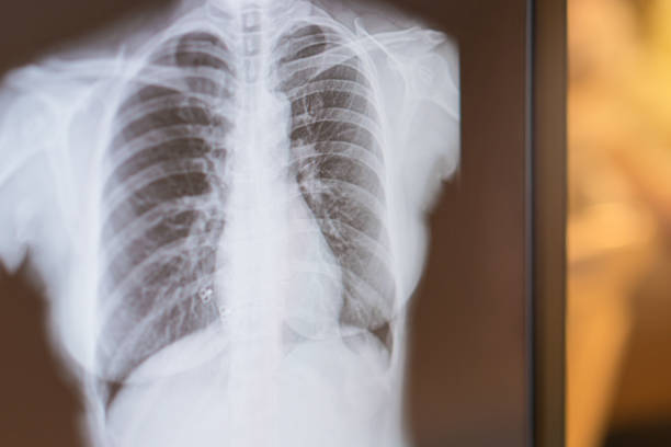 肺腫瘍、肺癌または肺炎に対する患者肺のx線画像。 - 16323 ストックフォトと画像