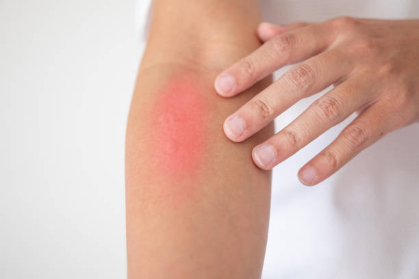 istock man itching and scratching on arm from itchy dry skin eczema dermatitis 1218865584