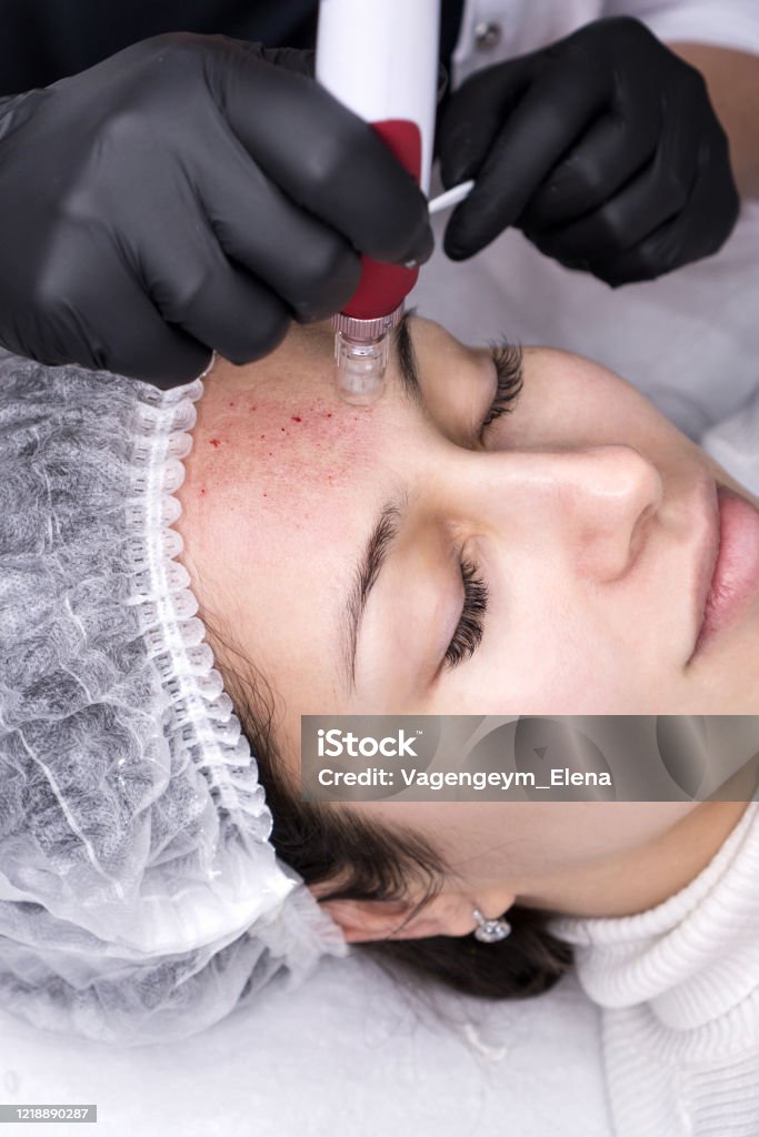 Micro needle mesotherapy. Derma pen Cosmetologist making mesotherapy injection. Microneedle mesotherapy. Treatment woman at beautician. Hardware cosmetology. Mesotherapy, dermapen, treatment of face zone, face rejuvenation. Collagen Induction Therapy Stock Photo