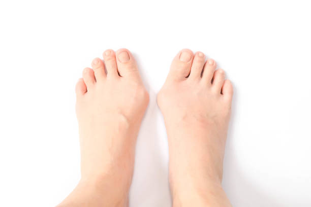 hallux valgus, piedi isolati sul bianco. hallux valgus è un termine medico per bunion foot / bunionette. hallox valgus è normalmente causato da scarpe genetiche e/o da scarpe troppo strette e tacchi alti. - misalignment foto e immagini stock