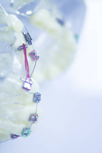 istock Model denture with metal orthodontics. No people 1218991211