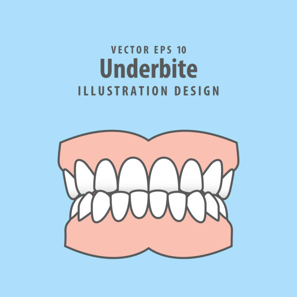 dental unterbiss zähne illustration vektor-design auf blauem hintergrund. zahnpflegekonzept. - fehlbiss stock-grafiken, -clipart, -cartoons und -symbole