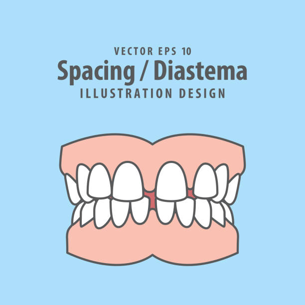 dentalabstand oder diastema zähne illustration vektor-design auf blauem hintergrund. zahnpflegekonzept. - beißring stock-grafiken, -clipart, -cartoons und -symbole