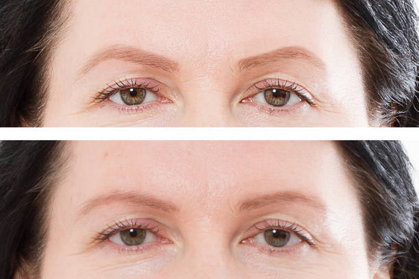 istock Before after eyebrow threading and eyebrows shaping cosmetic procedure. Closeup middle age woman face. Before-after skin and forehead. Anti aging concept 1219032307